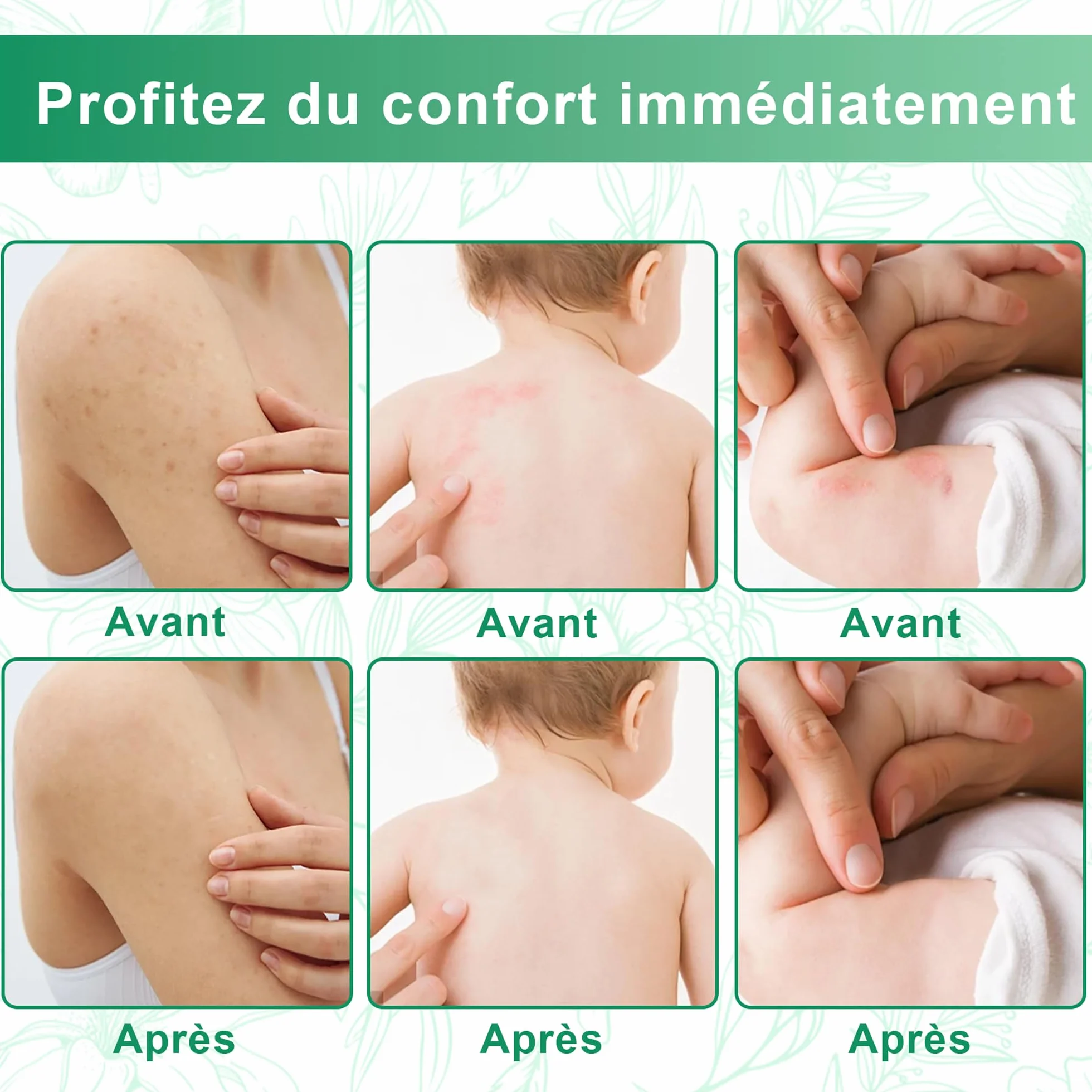 Crème antifongique à base de plantes pour pied d'athlète, teigne, eczéma marginé de Hebra
