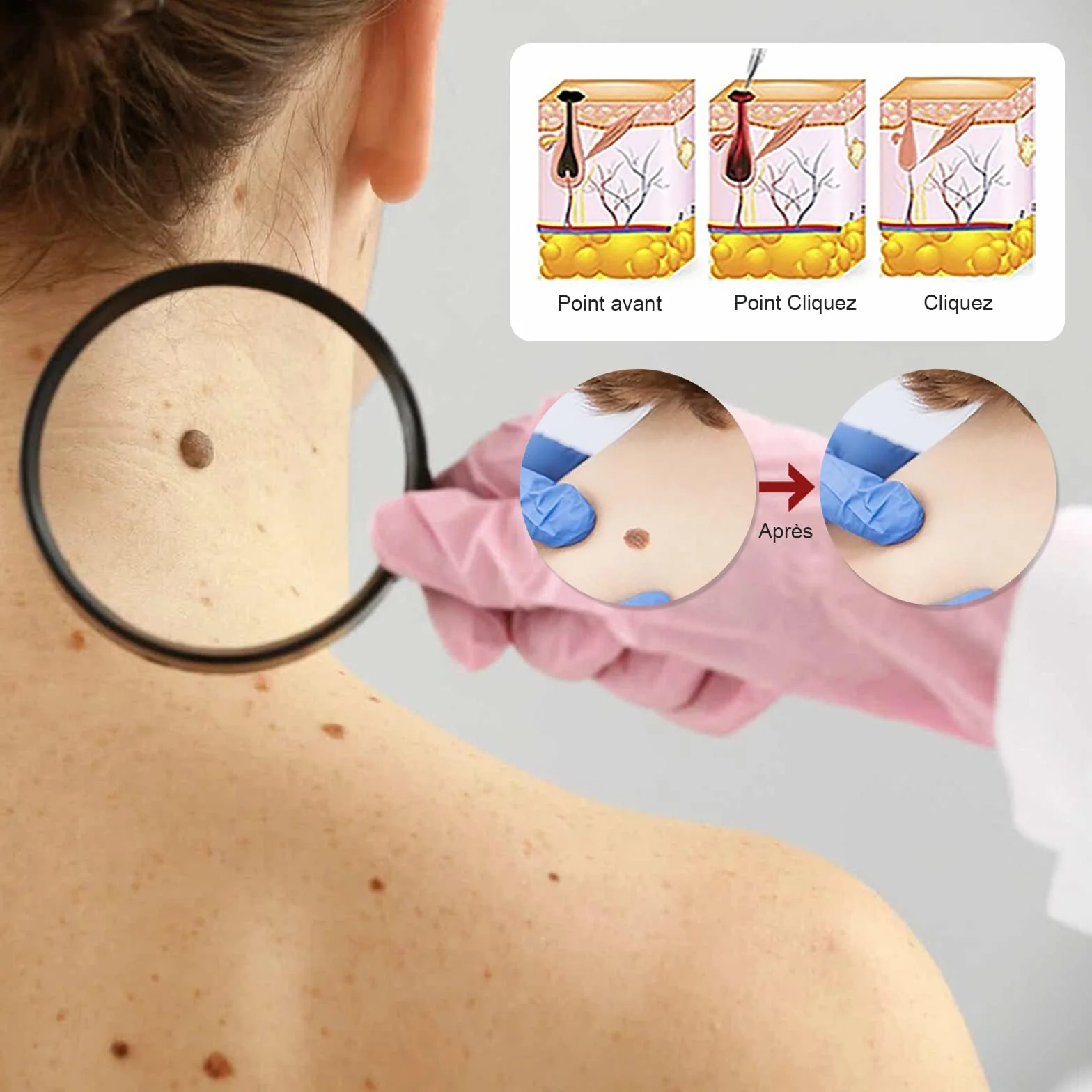 Action Enlèvement Des Acrochordons – Pipette Précision Visage & Corps | Élimination Ciblée des Verrues Plantaires, Vulgaire et Plates | Formule Douce à, Format Voyage(10ml)