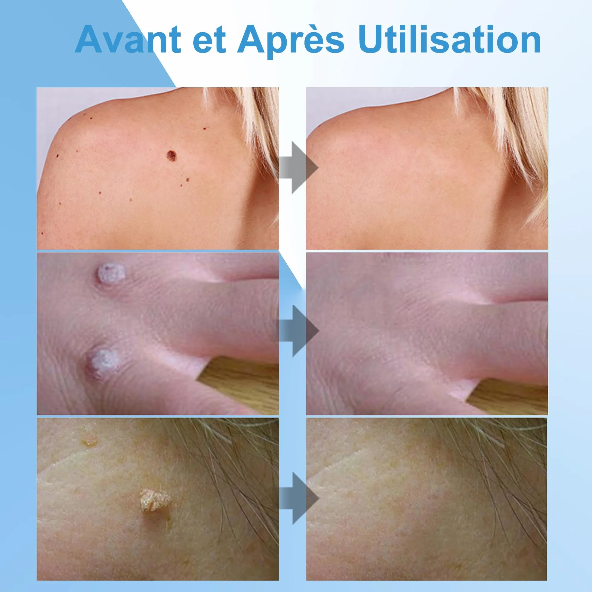 Crème Anti Verrue 20g Élimination Verrues Plantaires Vulgaris Cors Planes