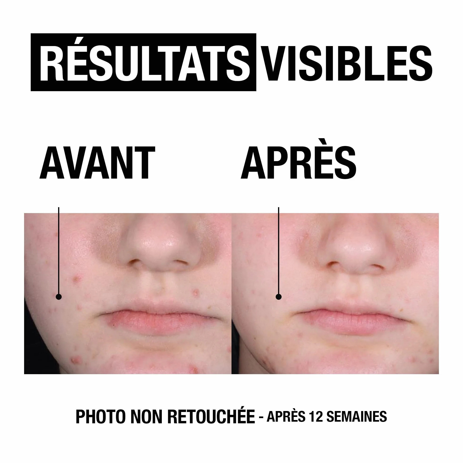 Neutrogena Gel Nettoyant Anti-Boutons Acide Salicylique 2% PHA 200 ml Soin Visage Peaux Acnéique
