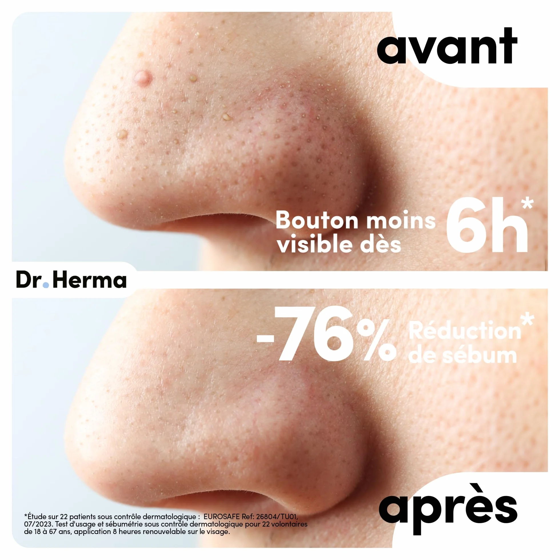 Dr. Herma Patch Anti Bouton Acide Salicylique Hydrocolloïdes Huile d'Arbre à Thé Boîte de 10 patchs