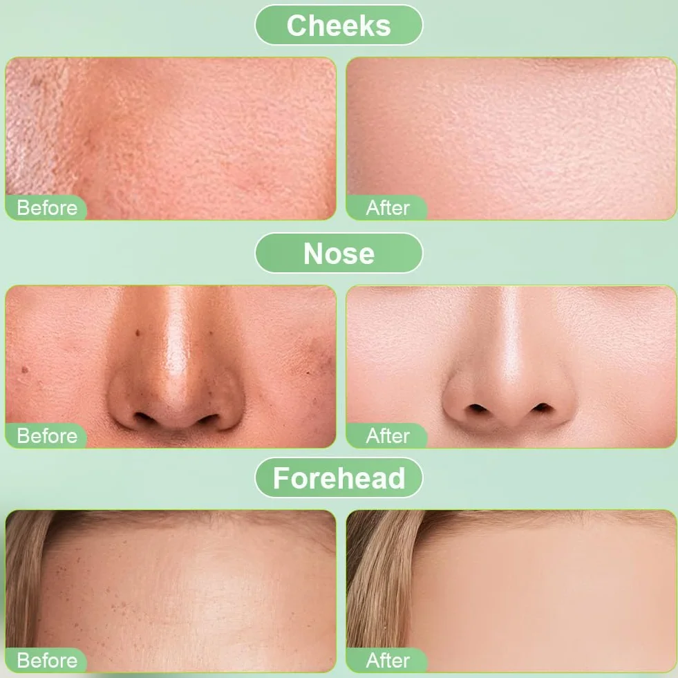 LOPHE Toner Pads Centella 100 pièces, Tampons Exfoliants Niacinamide, Correcteur Taches Sombres