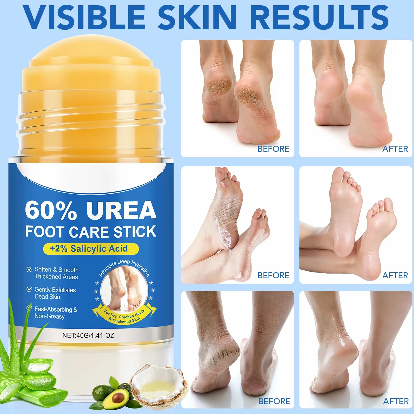 Crème pour les pieds 60% urée + 2% acide salicylique éliminateur de callosités exfoliant hydratant talons gercés (1 Pack)
