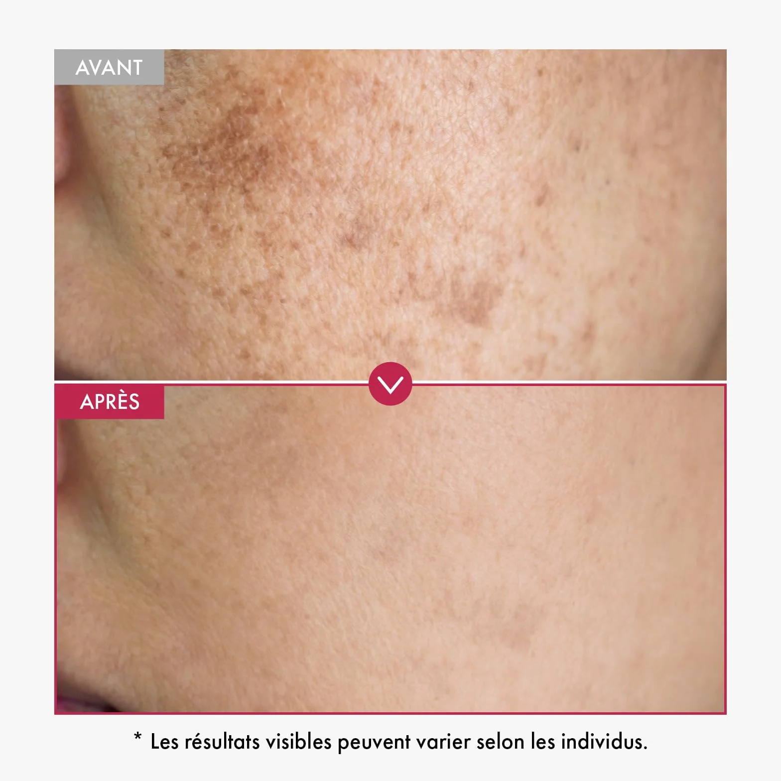 Sérum à 10% de Niacinamide + 4% d'acide tranexamique, 2% d'arbutin, acide hyaluronique, Sérum facial TXA, Soin de peau coréen, 33ml