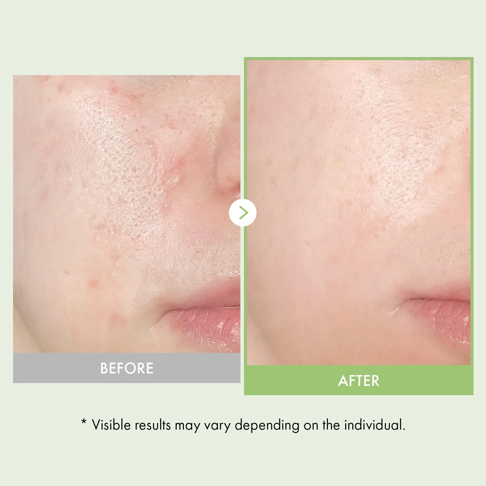 Duo Apaisant & Hydratant : Sérum Visage Acide Azélaïque 10% & Ampoule Real Relief Noni TOSOWOONG pour une Peau Claire et Éclatante